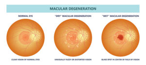 Illustration of macular degeneration compared to a normal eye