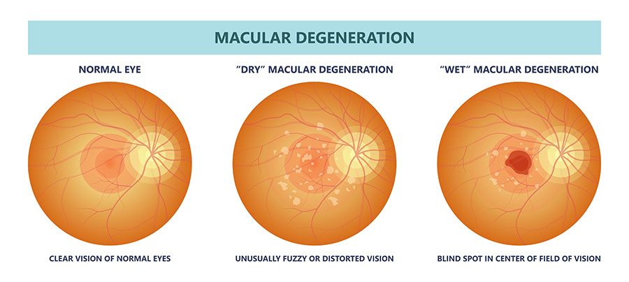 Illustration of macular degeneration compared to a normal eye